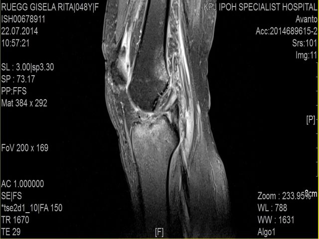 Eines von 300 Bilder von Gisi's Knie nach dem MRI.